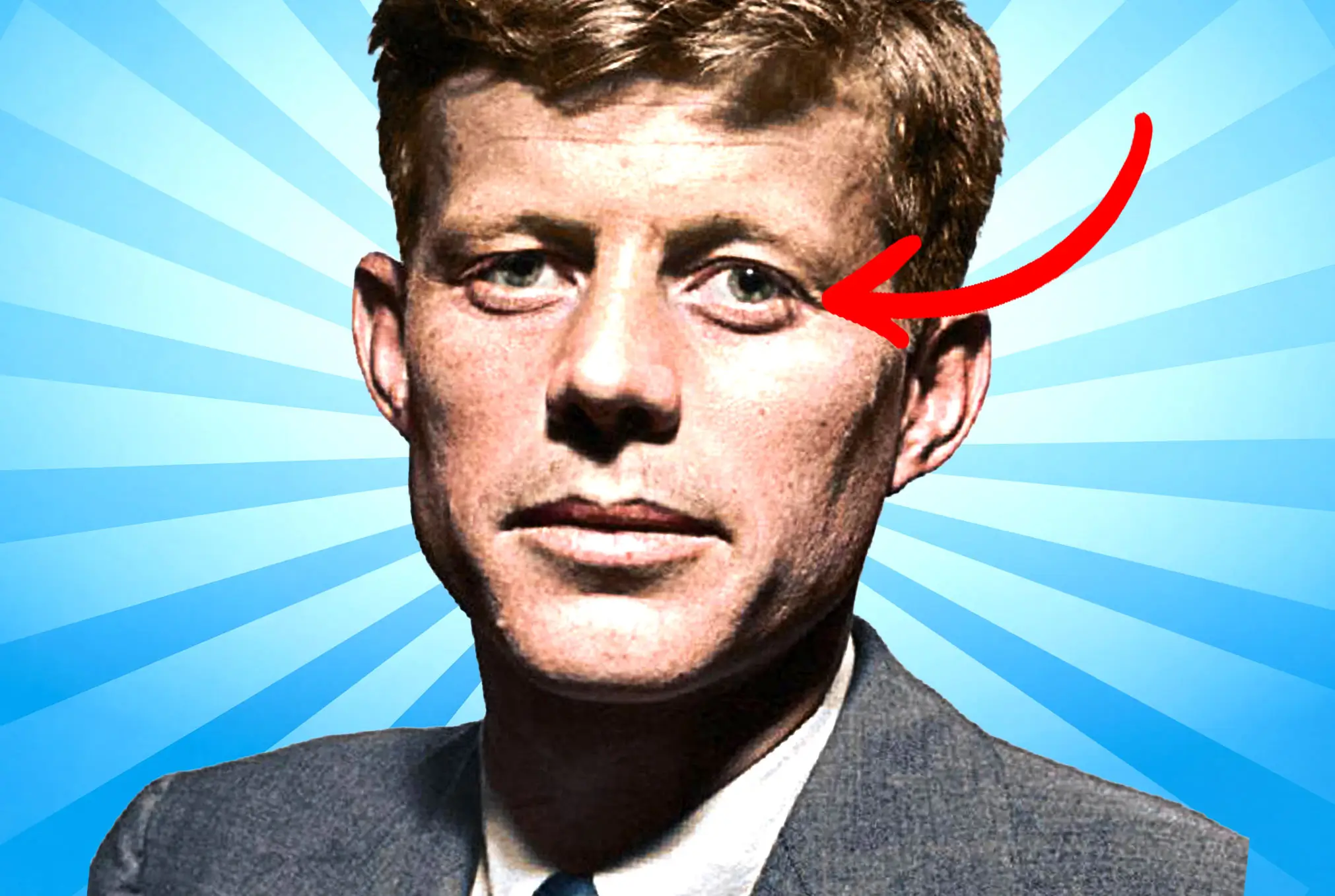 John F. Kennedy lazy eye