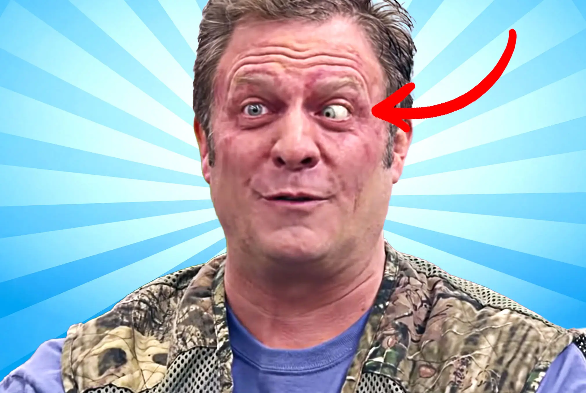 Jonathan Loughran lazy eye