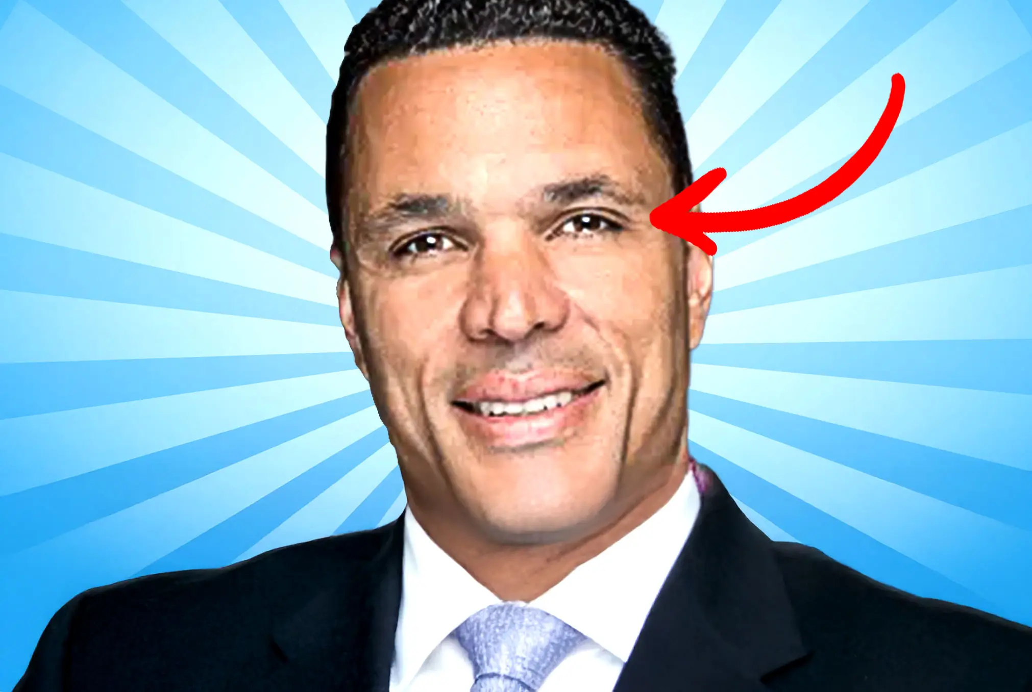 Tony Gonzalez lazy eye