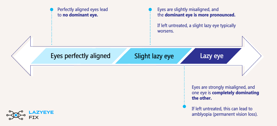 Eye Dominance: When To Worry
