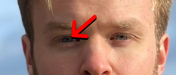 eye misalignment in amblyopia